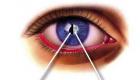 Какие могут быть последствия катаракты, если не делать операцию?
