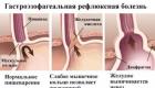 Gastroezofaginio refliukso liga: kaip atpažinti ir išgydyti?